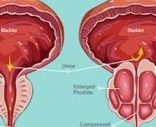 Prostrate gland